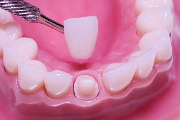 A Guide To The Dental Crown Process