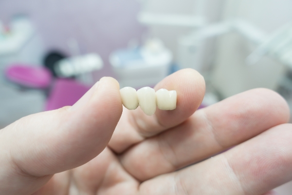 Exploring Different Options For Dental Bridges And Their Benefits