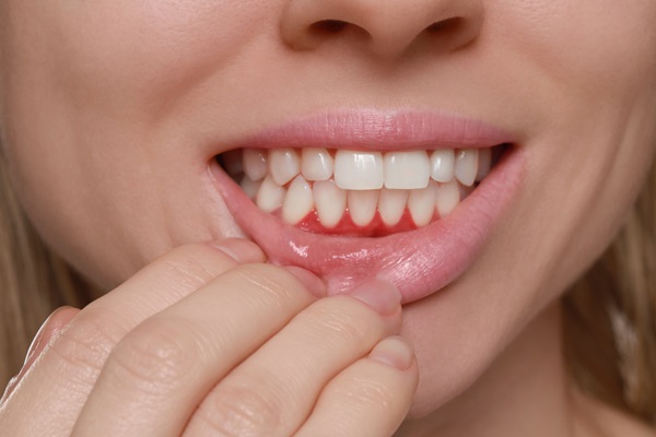 Important FAQs About Gum Disease