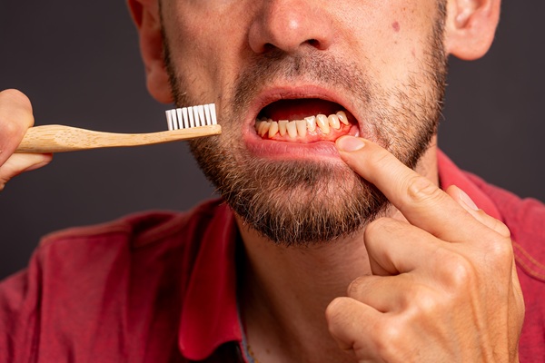 Gum Disease Treatment: Stages, Best Therapies, And How To Prevent Its Return