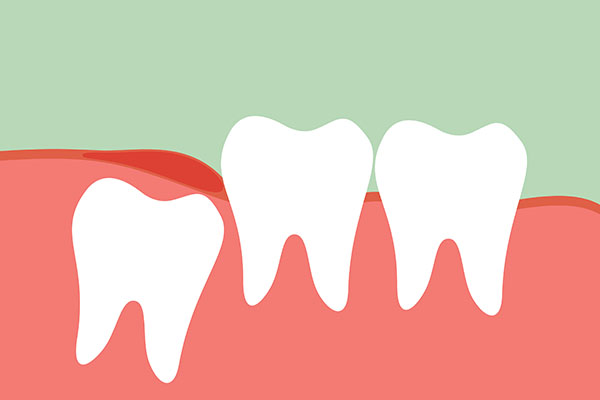 Impacted Wisdom Teeth And Infection